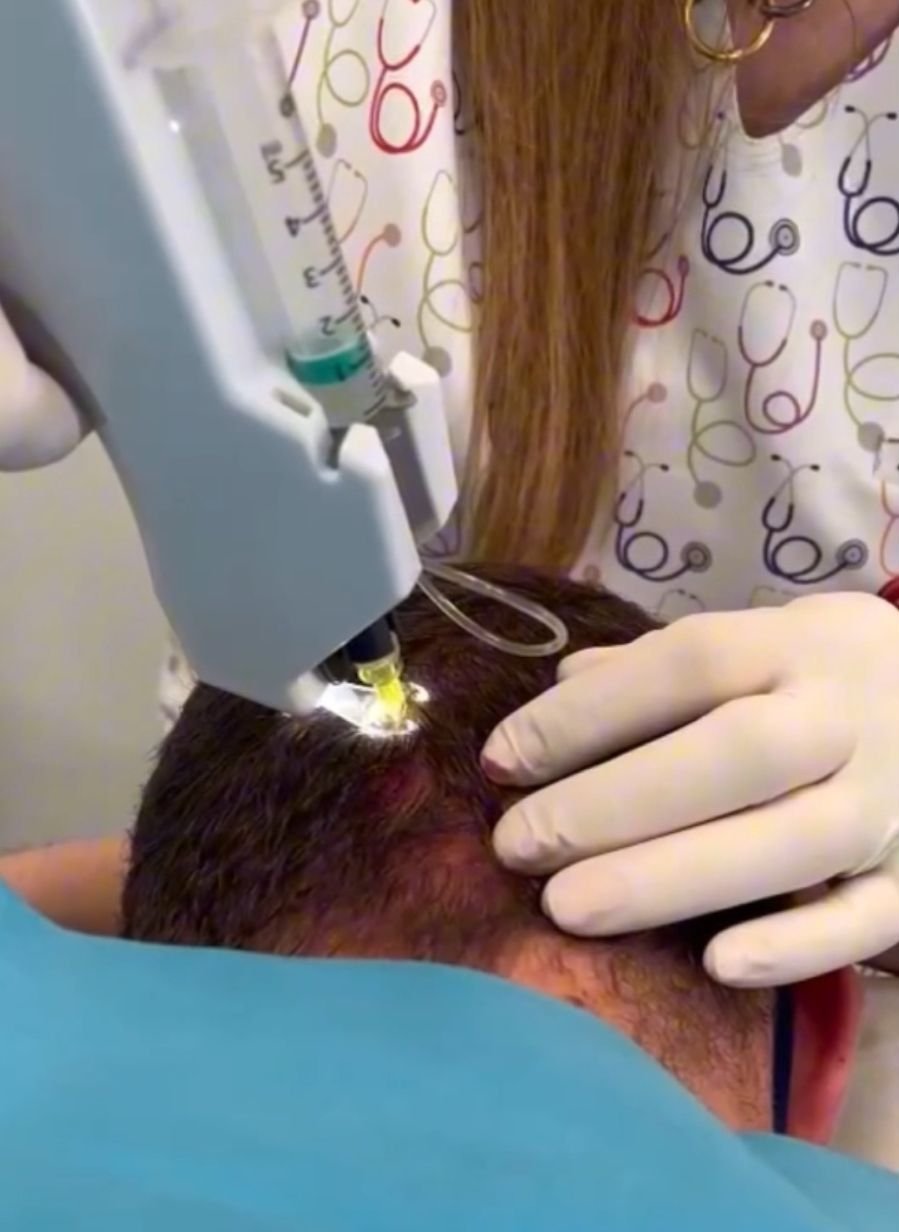 Aplicación de bioestimulación capilar con plasma rico en plaquetas en el cuero cabelludo